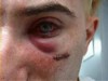 After_allergy_test.jpg