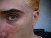 before_allergy_test.jpg